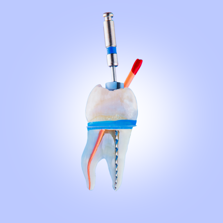 Root Canal Treatment