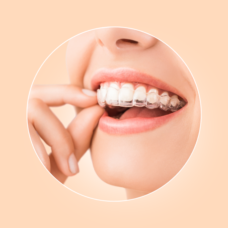 aligners treatment in mumbai