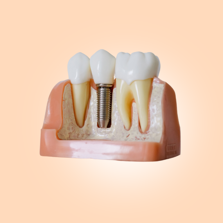 dental implant in mumbai